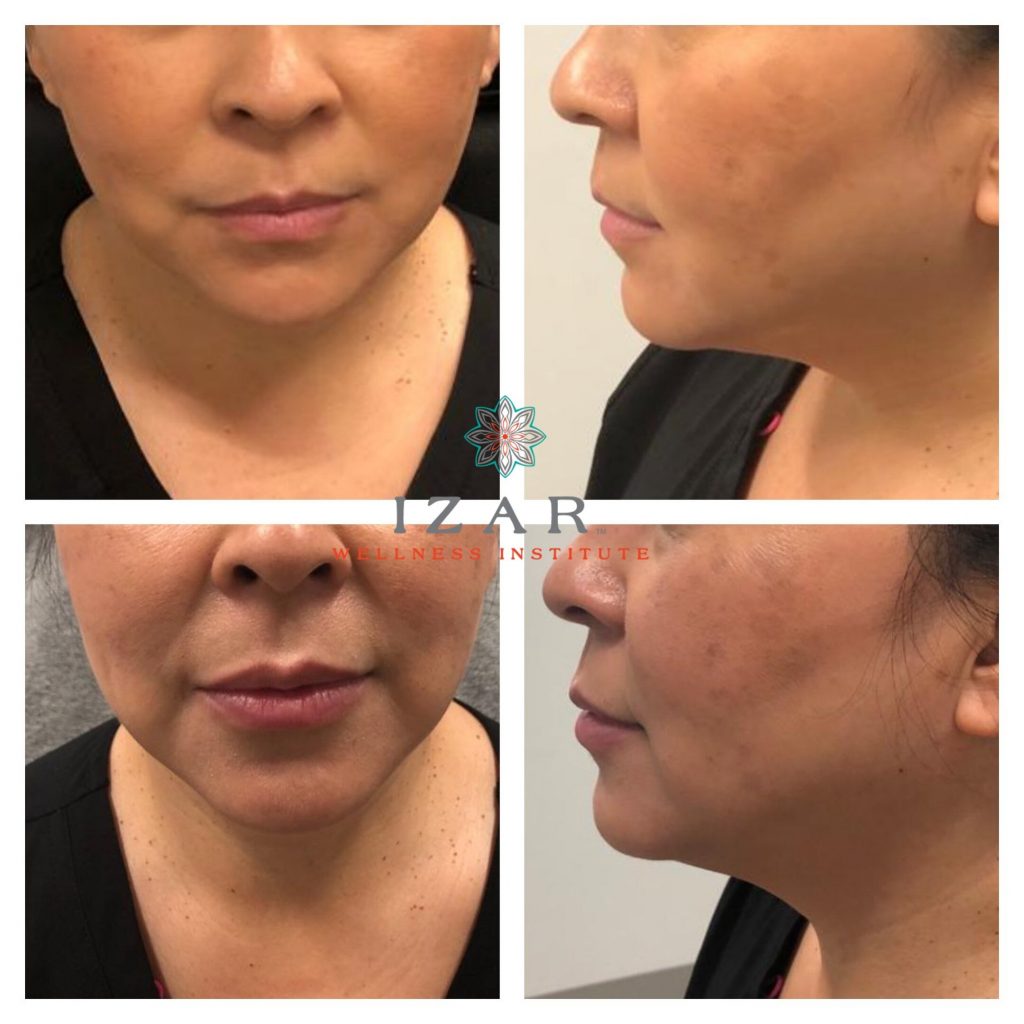 skin plasma tightening